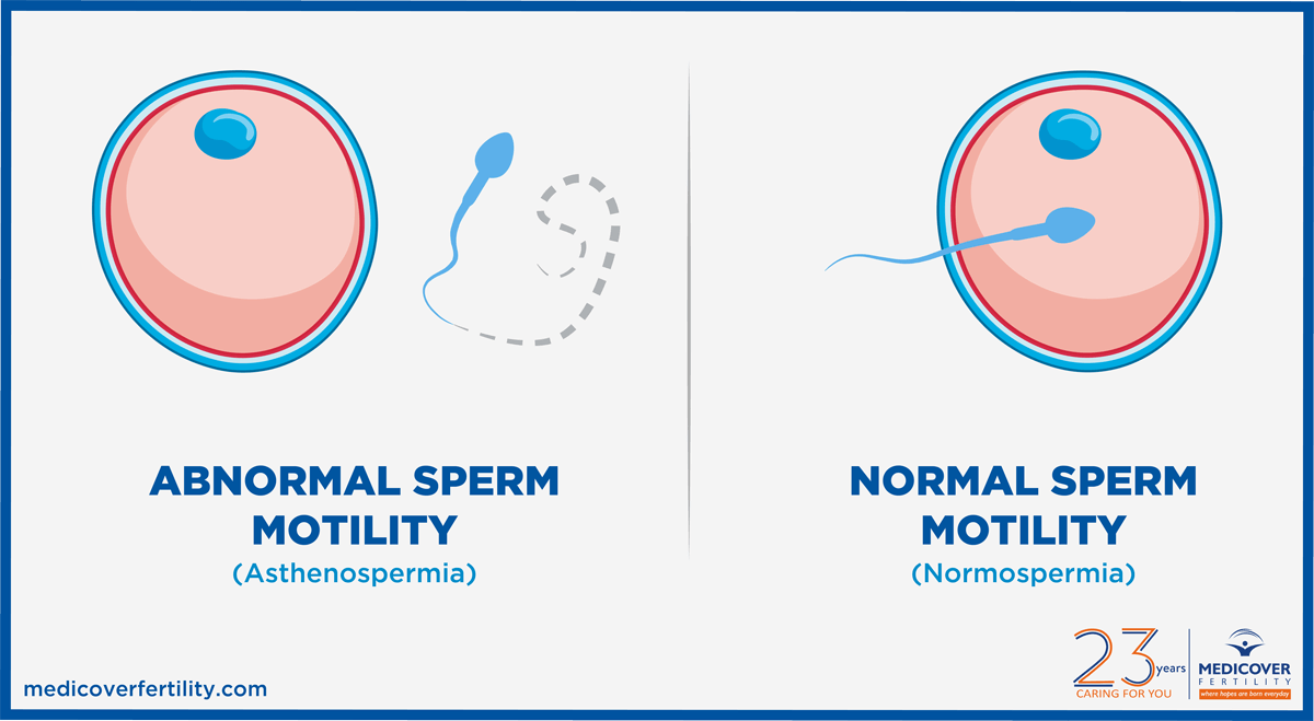¿Qué causa la baja motilidad de los espermatozoides?